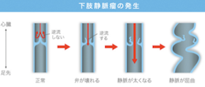 静脈瘤の説明図